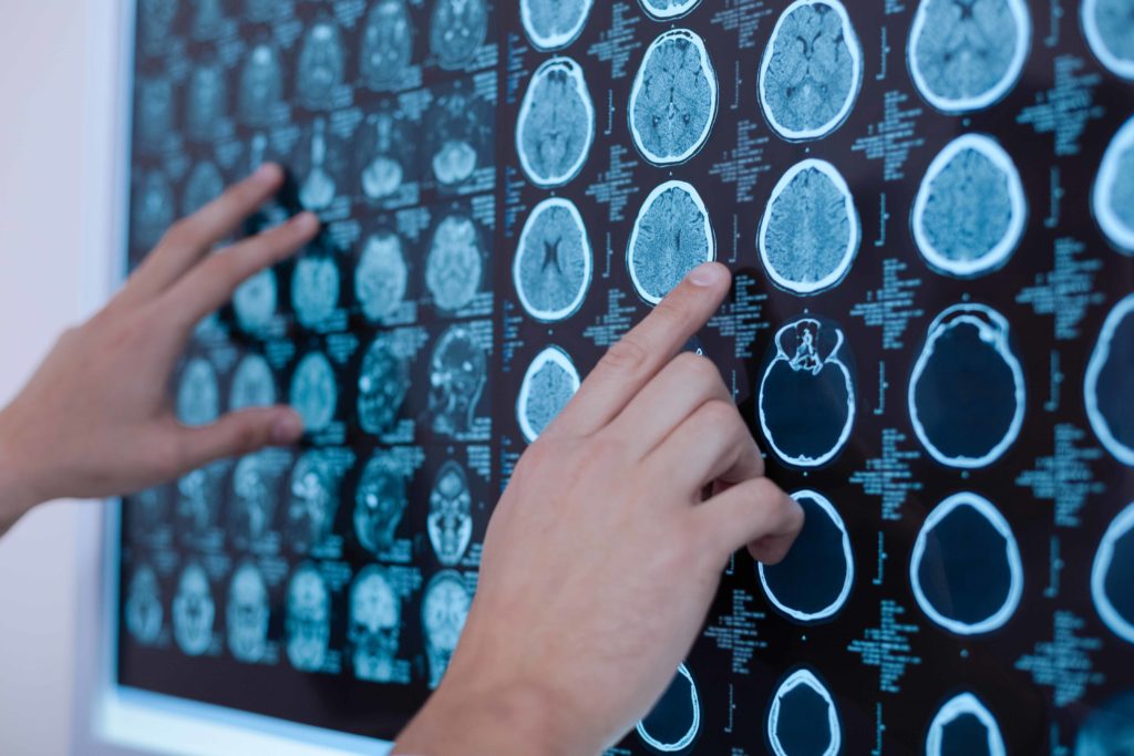 ABCD2 Score System for stroke risk assessment after suspected TIA, online calculator