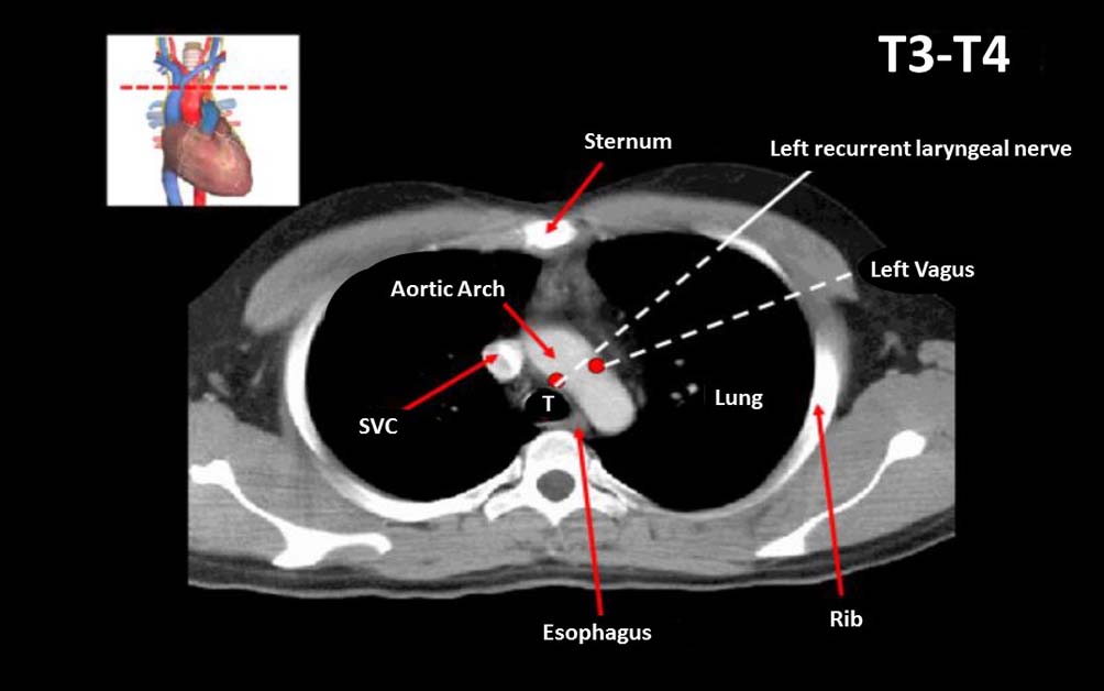 Computed tomography, CT, chest, chest structures, Chest CT scan