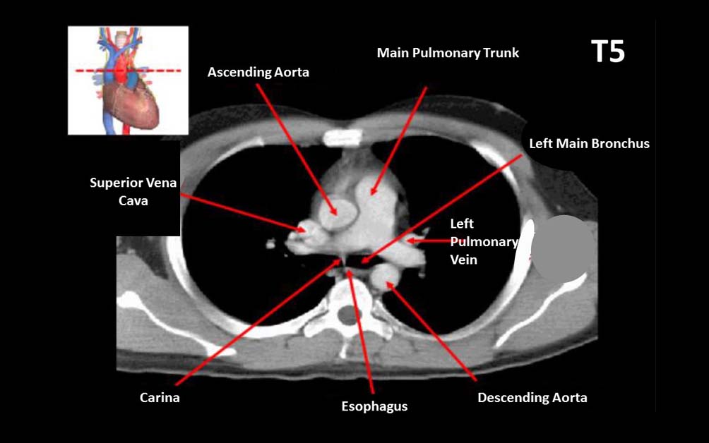 Computed tomography, CT, chest, chest structures, Chest CT scan
