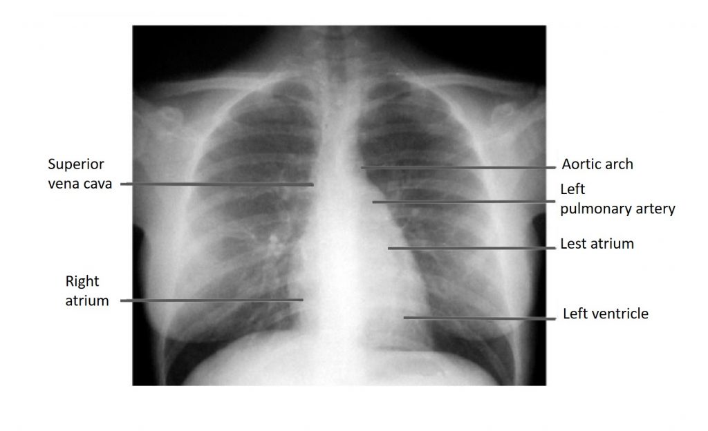 X-ray Heart Borders | ClinCaseQuest