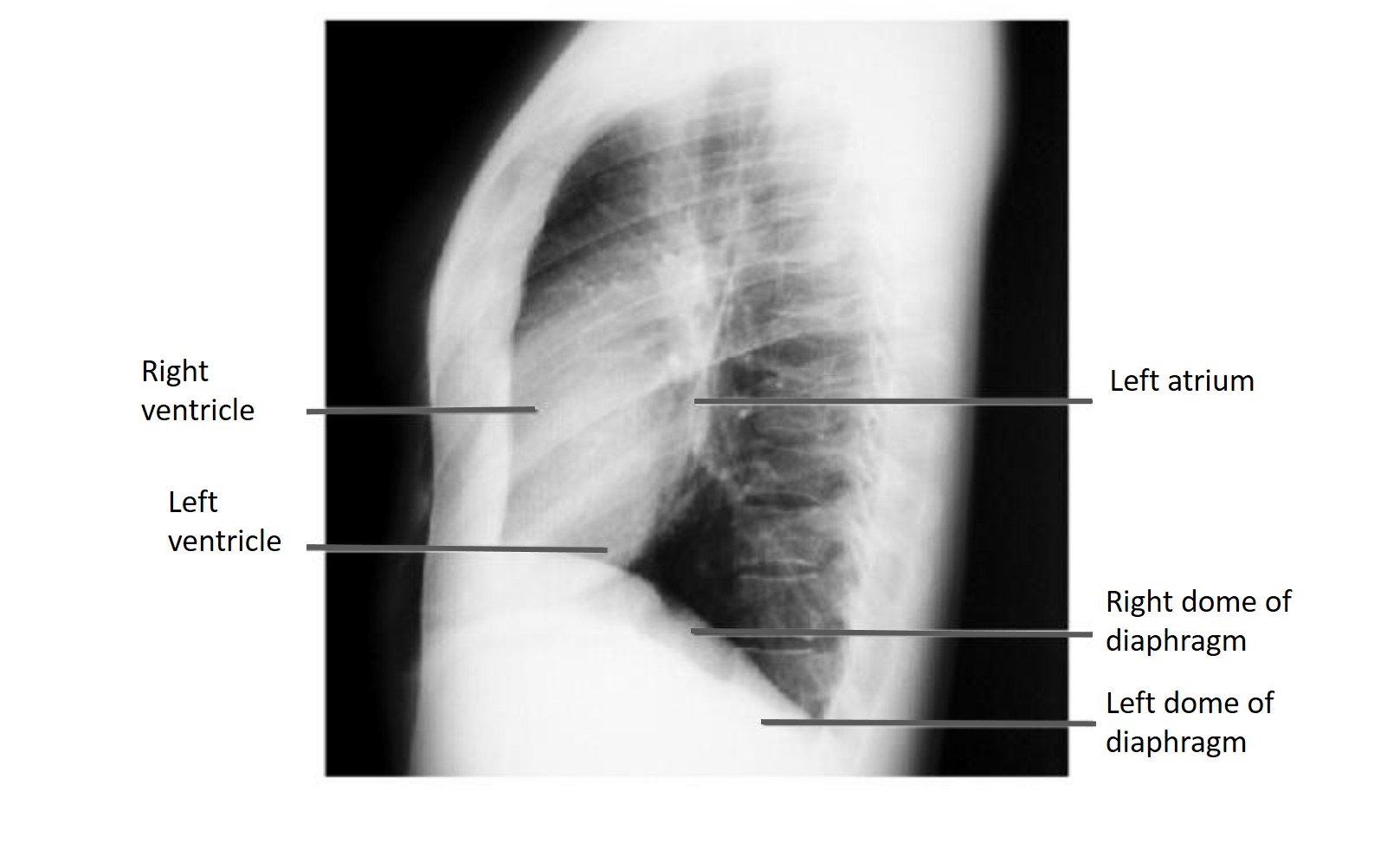 X-ray Heart Borders, X-ray, heart borders, radiological, radiology, heart x-ray, chest x-ray, heart borders on x-ray, determination of heart borders