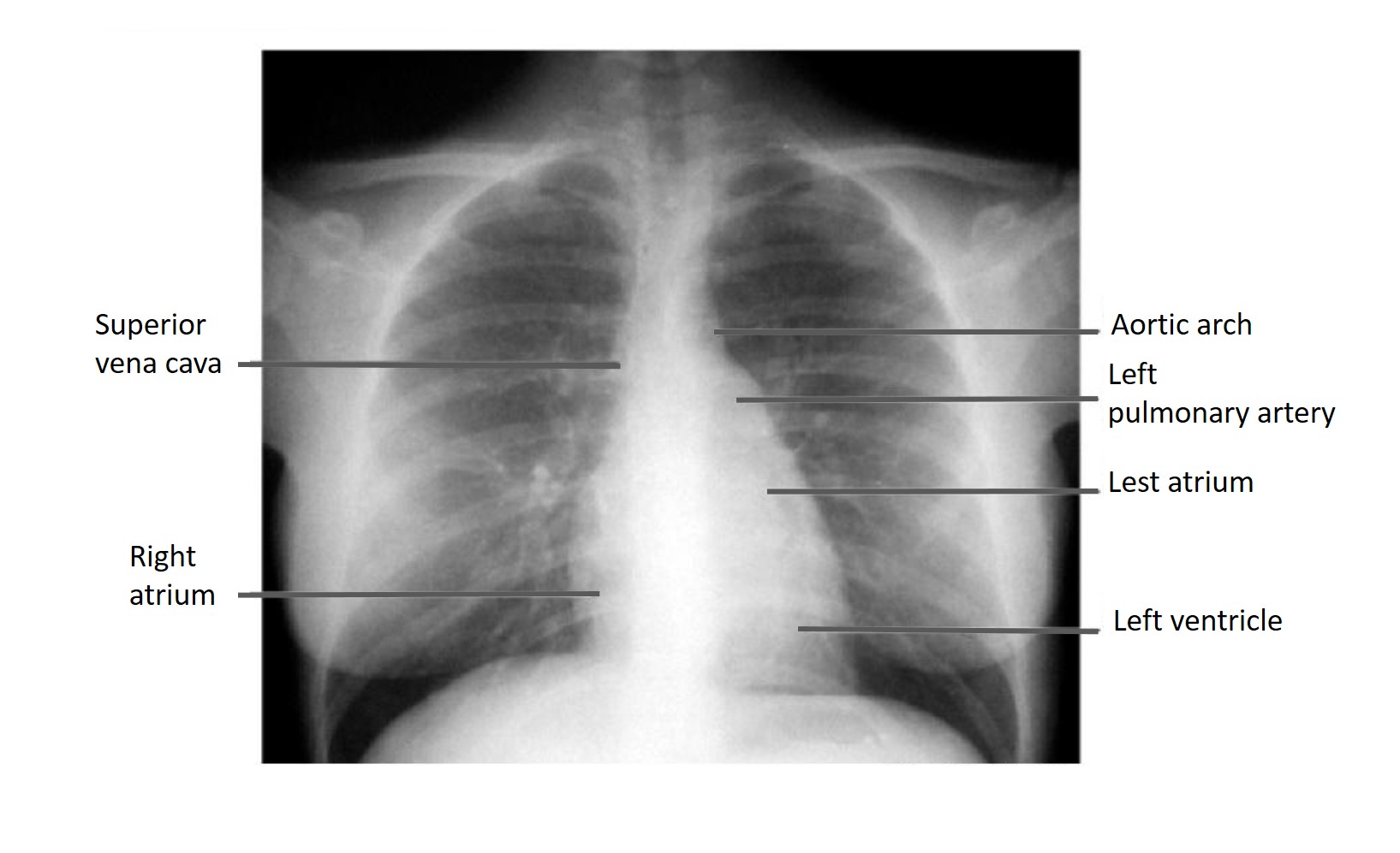 X-ray Heart Borders, X-ray, heart borders, radiological, radiology, heart x-ray, chest x-ray, heart borders on x-ray, determination of heart borders