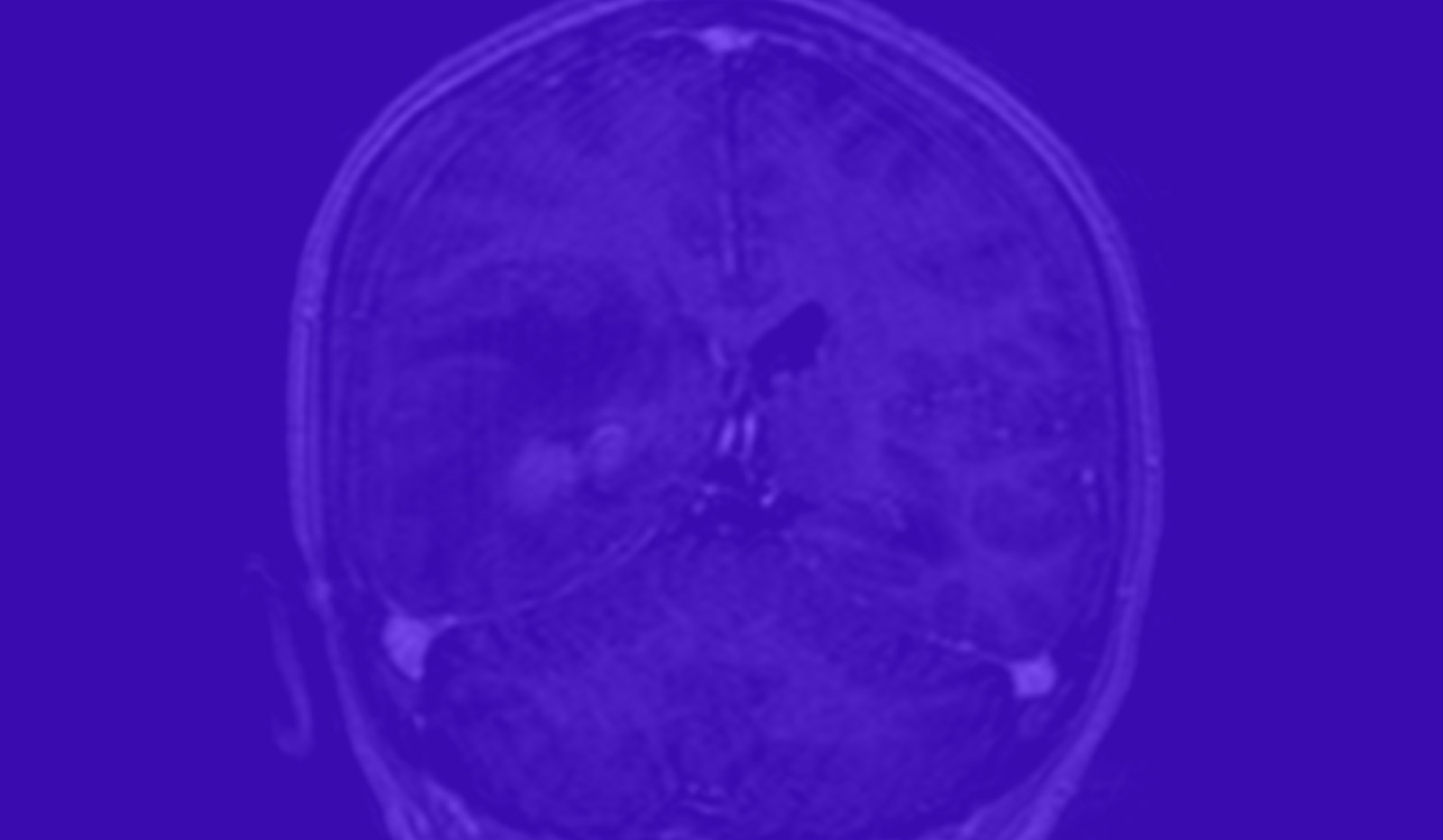 A patient with severe neurological symptoms in the hematology department